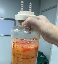 定西水动力吸脂手术要做多久？